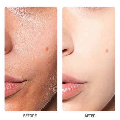 Skinever SALICYLIC ACID Refreshing Scrub Cleanser 75ml - Deep Cleansing Exfoliating Cleanser - ACNE TREATMENT